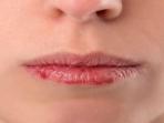 Atasi Bibir Pecah-pecah dengan 5 Bahan Alami Ini