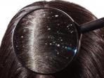 Benarkah Penyebab Utama Rambut Berketombe Karena Jamur? Simak Penjelasannya Yuk