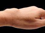 Cara Menghilangkan Kista Ganglion di Tangan Tanpa Operasi