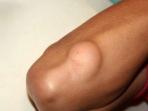Mengenal Benjolan Lemak di Bawah Kulit Lipoma, Berbahayakah?