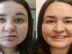Awas Keliru, Kenali Gejala Bell's Palsy yang Sering Menjangkit di Usia Muda