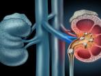 Beberapa Makanan Ini Ternyata Bisa Menyebabkan Batu Ginjal