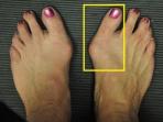 Kenali Penyebab Pergeseran Tulang Ibu Jari Kaki atau Bunion yang Sering Dialami Para Wanita