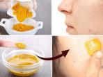 Cukup Pakai Kunyit, Begini Cara Ampuh Hilangkan Bekas Jerawat di Wajah