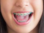 Girls, Begini Cara Mencegah Gigi Kuning Setelah Memakai Behel
