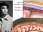 Glenn Fredly Berpulang, Waspadai Cara Penularan Penyakit Meningitis