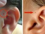Perhatikan Apakah Ada Lubang Kecil di Atas Daun Telinga Anda? Jika Ya, Wajib Simak Penjelasan Ini