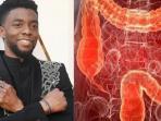 Waspadai 6 Gejala Kanker Usus Besar, Penyakit yang Sebabkan Aktor Utama Black Panther Meninggal Dunia