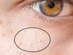 Jangan Panik, Ini 5 Kunci Menghilangkan Bintil-bintil Putih di Kulit Wajah