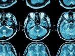 Penyakit Mematikan, Waspada 8 Gejala Awal Tumor Otak yang Perlu Diketahui