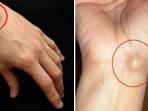 Pernah Temukan Benjolan Seperti Ini di Tangan? Tenang, Simak Penjelasannya