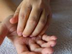 Telapak Tangan Sering Gatal? Awas, Bisa Jadi 9 Hal Ini Penyebabnya