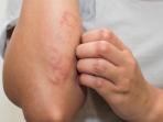 Waspadalah, 5 Kebiasaan Wanita Ini Bisa Memicu Kanker Kulit