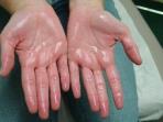 Alami Keringat Berlebihan pada Telapak Tangan dan Kaki? Ini Penyebab dan Cara Mengatasinya
