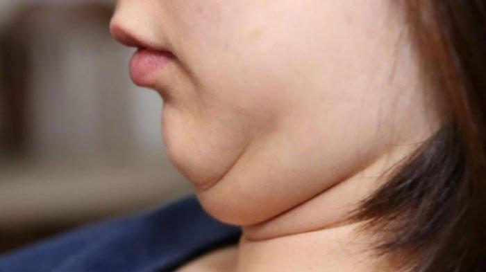 Simak 4 Tips Menyamarkan Hingga Menghilangkan Double Chin, Salah Satunya Rutin Minum Air Putih