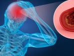 Waspada Jika Tubuh Mengalami Tanda Ini, Bisa Jadi Gejala Stroke