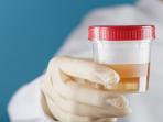 Cara Simpel Mengetahui Kesehatan Tubuh Lewat Warna Urine