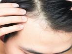 Pria Rentan Alami Kebotakan? Tenyata Ini Penyebabnya