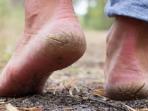 6 Penyebab Tumit Kaki Kering dan Pecah-Pecah yang Tanpa Disadari