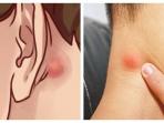 Awas, Ada Penyakit Berbahaya Tersembunyi Dibalik Tanda Benjolan di Leher atau Belakang Telinga