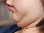 Ternyata Punya Double Chin Bisa Bahayakan Kesehatan Loh, Kok Bisa?