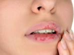 Jangan Lagi Lakukan, Ini Bahaya Punya Kebiasaan Mengelupas Kulit Bibir yang Kering