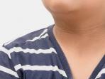 12 Tanda Seseorang Mengidap Diabetes, Bisa Dilihat dari Kondisi Kulit