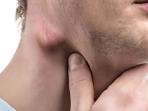 4 Penyebab Kelenjar Getah Bening Membengkak yang Tak Boleh Anda Abaikan
