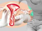 Berikut 4 Ciri Kista Ovarium yang Perlu Anda Waspadai