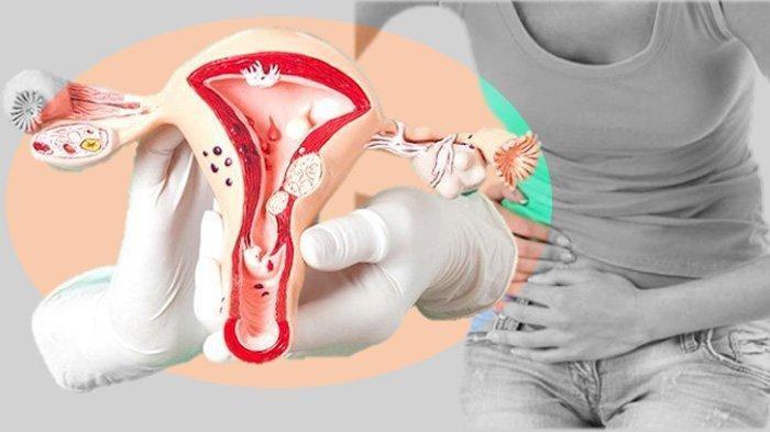 Berikut 4 Ciri Kista Ovarium yang Perlu Anda Waspadai