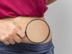 Rekomendasi Produk untuk Menghilangkan Stretch Mark, Kulit Makin Mulus
