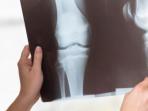 Waspadai Bahaya Tubuh Kekurangan Kalsium, Kenali 7 Tandanya