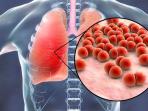 Ketahui Ciri Paru-paru Terkena Penyakit Infeksi Pneumonia, Tangani Sebelum Terlambat
