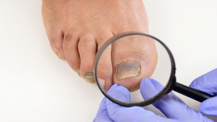 Kuku Cantengan Ternyata Terjadi Karena 5 Kebiasaan yang Tak Disadari Ini