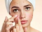 Ketahui, Ini 5 Cara Menghilangkan Jerawat Secara Cepat
