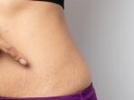 Begini Cara Mudah Hilangkan Stretch Mark Pakai Bahan Alami