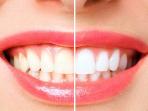5 Cara Mudah Bikin Gigi Tampak Lebih Putih Secara Alami