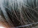 Bahaya Kutu Rambut jika Tidak Segera Diatasi, Begini Cara Menghilangkannya