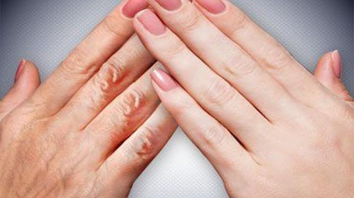 Kulit Keriput Tersamarkan dengan Cepat Hanya dengan Bahan Alami Mudah Didapat