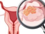 Wajib Tahu, 6 Gejala Awal Kanker Rahim Stadium Satu