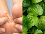 5 Obat Alami untuk Atasi Kutu Air di Kaki