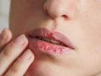 Kamu Wajib Tahu, Ini 6 Obat Alami untuk Mengatasi Bibir Pecah-pecah