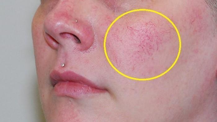 Penyebab Spider Veins yang perlu segera ditangani agar tidak menjadi masalah dikemudian hari.