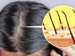 Simak Penjelasan Mengenai Penyebab Rambut Berketombe, Benarkah karena Jamur?