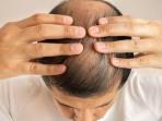 Cukup Mudah, Simak 5 Cara Mengatasi Kebotakan Dini Secara Alami 