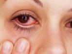 Mudah dan Cepat Pulih, Ini 10 Cara Mengatasi Mata Merah dan Gatal 