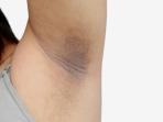 Pakai Deodoran Bikin Ketiak Hitam? Simak Yuk Cara Ampuh Mengatasinya dengan Bahan Alami