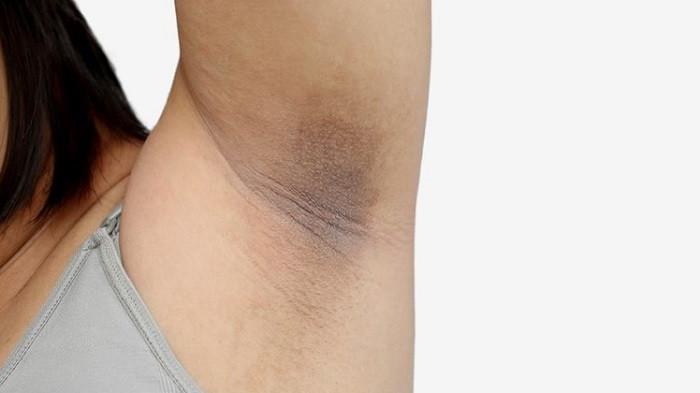 Pakai Deodoran Bikin Ketiak Hitam? Simak Yuk Cara Ampuh Mengatasinya dengan Bahan Alami