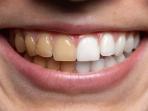Rekomendasi 4 Merek Whitening Strip, Aman dan Ampuh Atasi Gigi Kuning