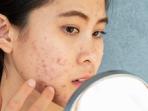 Wajib Tahu, 4 Kandungan Skincare untuk Menyamarkan Bekas Luka Jerawat